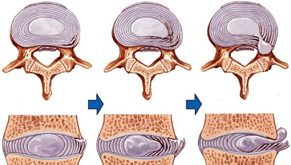 spine injury in osteochondrosis
