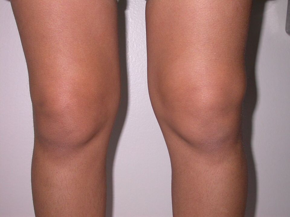 knee swelling due to osteoarthritis