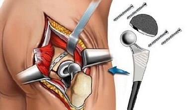 Endoprotetic for hip arthrosis