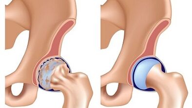 Hip Articulation Arthrosis symptoms