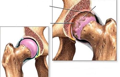Hip arthrosis diagnosis