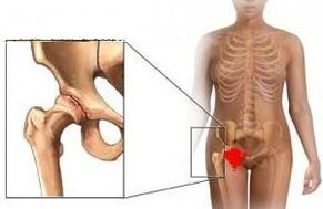 The reasons for the development of hip joint arthrosis