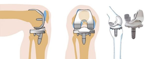 Endoproptic operation of knee articulation for arthrosis