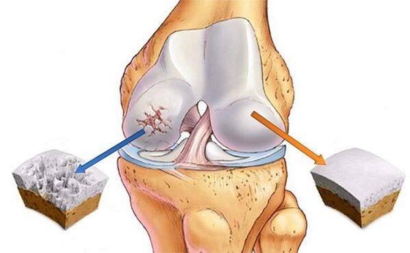 norm and deviation for knee joint arthrosis