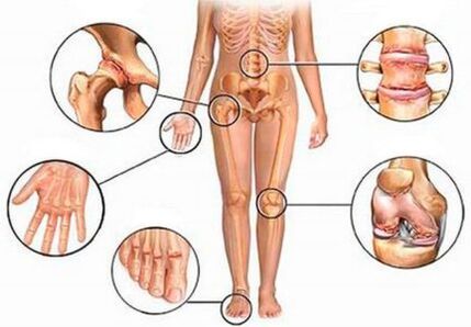 Arthritis and arthrosis of various articulations
