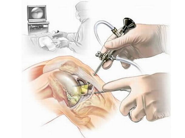 Knee articulation arthroscopy