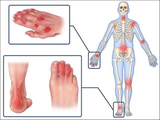 Skin redness and arthritis joint swelling