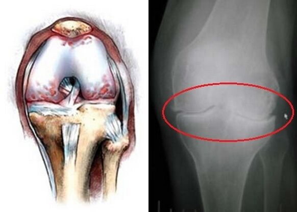 The deformation of the knee joint for arthrosis