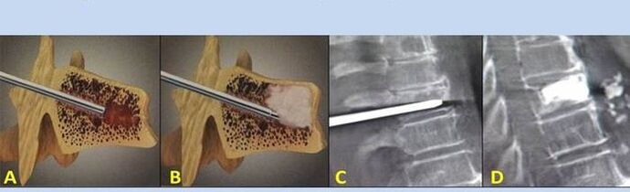 punch vertebroplasty for back pain