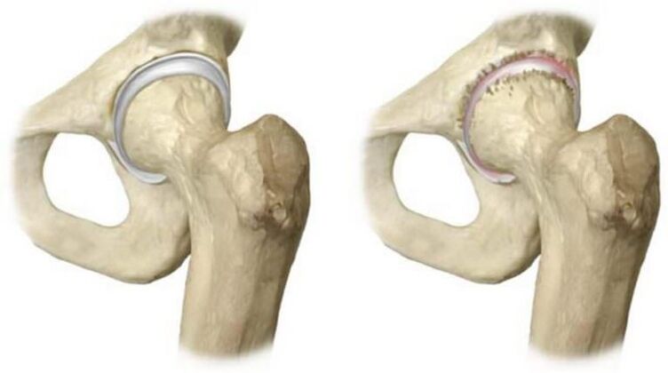 healthy hip joint and head necrosis as a cause of pain