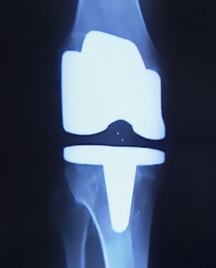 X-ray of knee with artificial prosthesis after joint replacement surgery