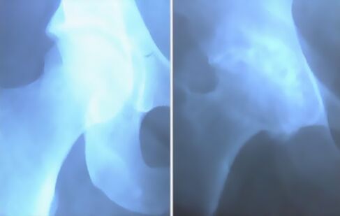 knee joint osteoarthritis image