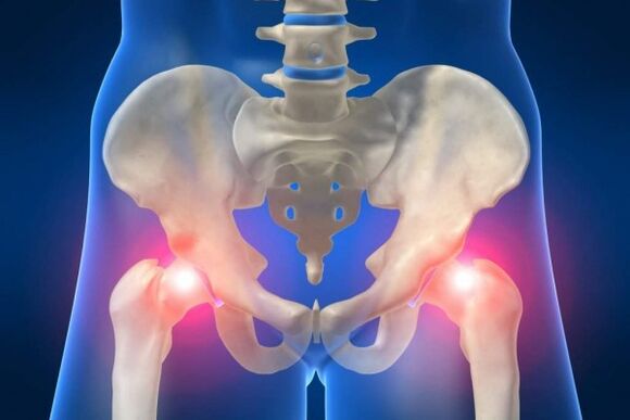 hip joint arthrosis